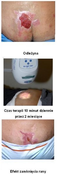 Leczenie ran Q.Light