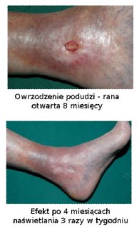 Leczenie rany wiatem Q.Light