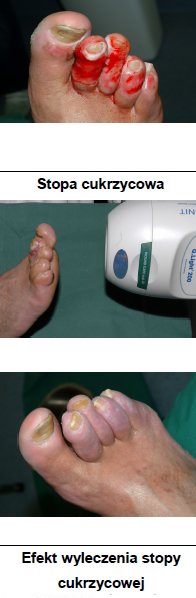 Sposb nawietlania cukrzycy Q.Light