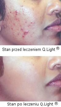 Efekty nawietlania trdziku Q.Light